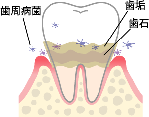 歯周病菌　歯垢　歯石